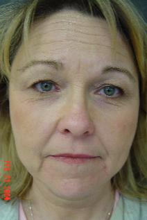 Facelift Before Photo by Ronald Friedman, MD; Plano, TX - Case 7557