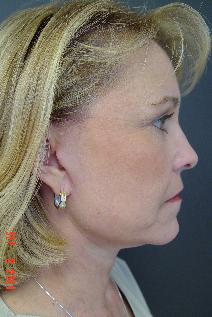 Facelift After Photo by Ronald Friedman, MD; Plano, TX - Case 7557