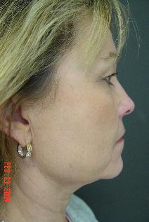Facelift Before Photo by Ronald Friedman, MD; Plano, TX - Case 7557