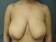 Breast Reduction Before Photo by Ronald Friedman, MD; Plano, TX - Case 7560