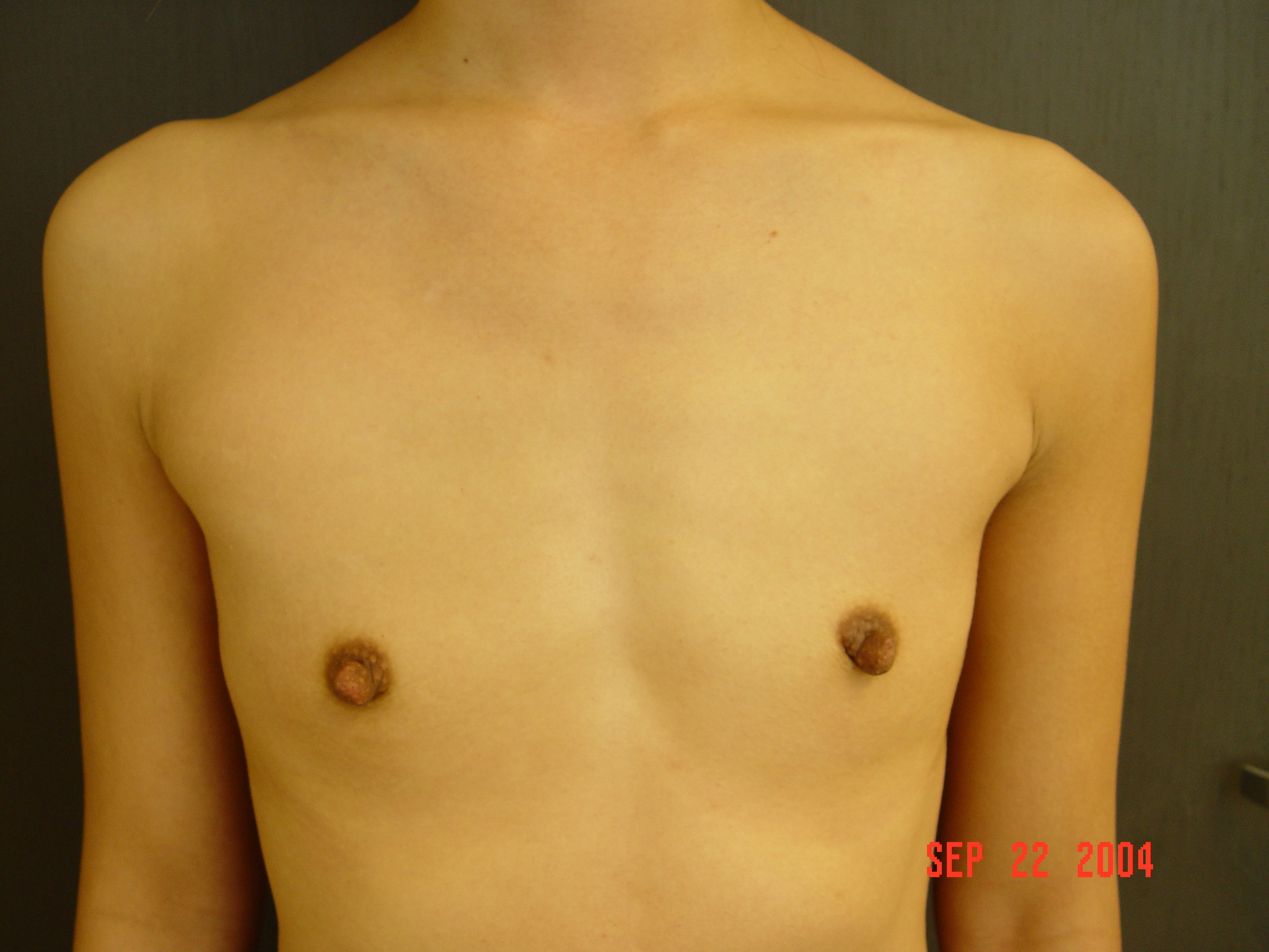 Breast Reduction Before and After Photos by Ronald Friedman, MD