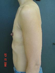 Breast Augmentation Before Photo by Ronald Friedman, MD; Plano, TX - Case 7755