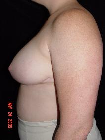 Breast Reduction After Photo by Ronald Friedman, MD; Plano, TX - Case 7855