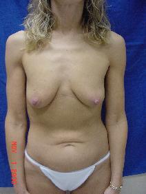 Tummy Tuck Before Photo by Ronald Friedman, MD; Plano, TX - Case 7872