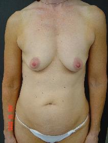 Tummy Tuck Before Photo by Ronald Friedman, MD; Plano, TX - Case 7873
