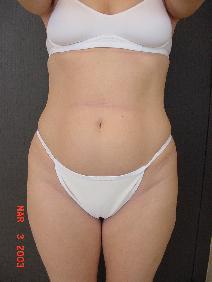 Tummy Tuck Before Photo by Ronald Friedman, MD; Plano, TX - Case 7875