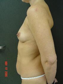 Tummy Tuck Before Photo by Ronald Friedman, MD; Plano, TX - Case 7876