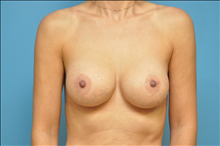 Breast Augmentation After Photo by D'Arcy Honeycutt, MD; Bismarck, ND - Case 24548