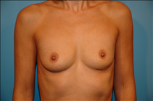 Breast Augmentation Before Photo by D'Arcy Honeycutt, MD; Bismarck, ND - Case 24548