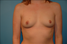 Breast Augmentation Before Photo by D'Arcy Honeycutt, MD; Bismarck, ND - Case 24549