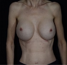 Breast Augmentation After Photo by Cynthia Poulos, MD; Northborough, MA - Case 33098
