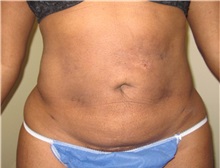 Liposuction After Photo by Thomas Wiener, MD; Houston, TX - Case 37350