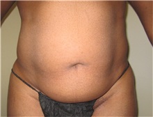 Liposuction Before Photo by Thomas Wiener, MD; Houston, TX - Case 37350
