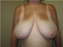 Breast Reduction Before Photo by Thomas Wiener, MD; Houston, TX - Case 37351