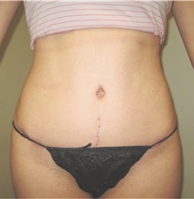 Tummy Tuck After Photo by Thomas Wiener, MD; Houston, TX - Case 37352