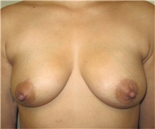 Breast Augmentation Before Photo by Thomas Wiener, MD; Houston, TX - Case 37353