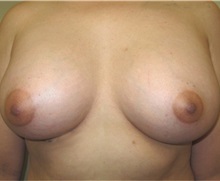Breast Augmentation After Photo by Thomas Wiener, MD; Houston, TX - Case 37354