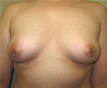 Breast Augmentation Before Photo by Thomas Wiener, MD; Houston, TX - Case 37354