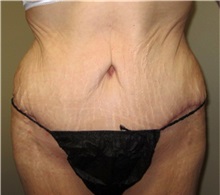 Tummy Tuck After Photo by Thomas Wiener, MD; Houston, TX - Case 37355