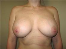 Breast Augmentation After Photo by Thomas Wiener, MD; Houston, TX - Case 37360