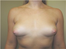 Breast Augmentation Before Photo by Thomas Wiener, MD; Houston, TX - Case 37362