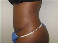 Tummy Tuck After Photo by Thomas Wiener, MD; Houston, TX - Case 37364