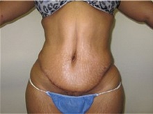 Tummy Tuck After Photo by Thomas Wiener, MD; Houston, TX - Case 37367