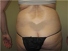 Liposuction Before Photo by Thomas Wiener, MD; Houston, TX - Case 37368