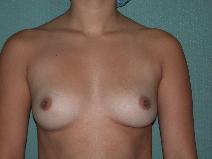 Breast Augmentation Before Photo by Stewart Wang, MD FACS; Pasadena, CA - Case 7923