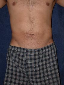 Liposuction After Photo by Stewart Wang, MD FACS; Pasadena, CA - Case 8003