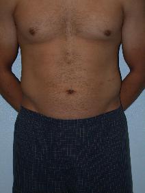 Liposuction Before Photo by Stewart Wang, MD FACS; Pasadena, CA - Case 8003
