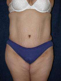 Tummy Tuck After Photo by Stewart Wang, MD FACS; Pasadena, CA - Case 9262
