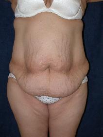 Tummy Tuck Before Photo by Stewart Wang, MD FACS; Pasadena, CA - Case 9262