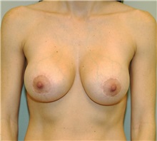 Breast Augmentation After Photo by Elisa Burgess, MD; Lake Oswego, OR - Case 26944