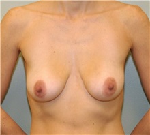 Breast Augmentation Before Photo by Elisa Burgess, MD; Lake Oswego, OR - Case 26944