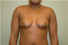 Breast Augmentation Before Photo by Elisa Burgess, MD; Lake Oswego, OR - Case 26945