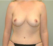 Breast Reduction After Photo by Elisa Burgess, MD; Lake Oswego, OR - Case 27300