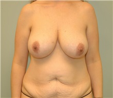 Breast Reduction Before Photo by Elisa Burgess, MD; Lake Oswego, OR - Case 27300
