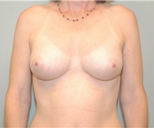 Breast Augmentation After Photo by Elisa Burgess, MD; Lake Oswego, OR - Case 27303