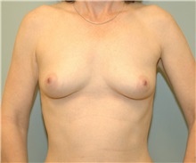 Breast Augmentation Before Photo by Elisa Burgess, MD; Lake Oswego, OR - Case 27303