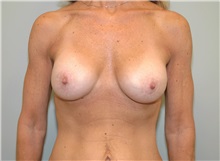 Breast Augmentation After Photo by Elisa Burgess, MD; Lake Oswego, OR - Case 27305