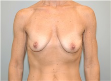 Breast Augmentation Before Photo by Elisa Burgess, MD; Lake Oswego, OR - Case 27305