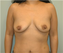 Breast Lift Before Photo by Elisa Burgess, MD; Lake Oswego, OR - Case 27308