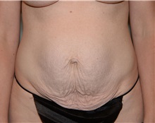 Tummy Tuck Before Photo by Elisa Burgess, MD; Lake Oswego, OR - Case 31239