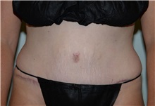 Tummy Tuck After Photo by Elisa Burgess, MD; Lake Oswego, OR - Case 31242