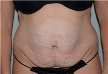 Tummy Tuck Before Photo by Elisa Burgess, MD; Lake Oswego, OR - Case 31242