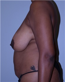 Breast Reduction Before Photo by Elisa Burgess, MD; Lake Oswego, OR - Case 31244