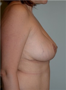 Breast Reduction After Photo by Elisa Burgess, MD; Lake Oswego, OR - Case 31247