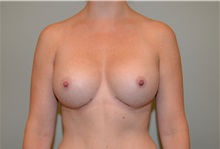 Breast Augmentation After Photo by Elisa Burgess, MD; Lake Oswego, OR - Case 32695