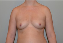 Breast Augmentation Before Photo by Elisa Burgess, MD; Lake Oswego, OR - Case 32695
